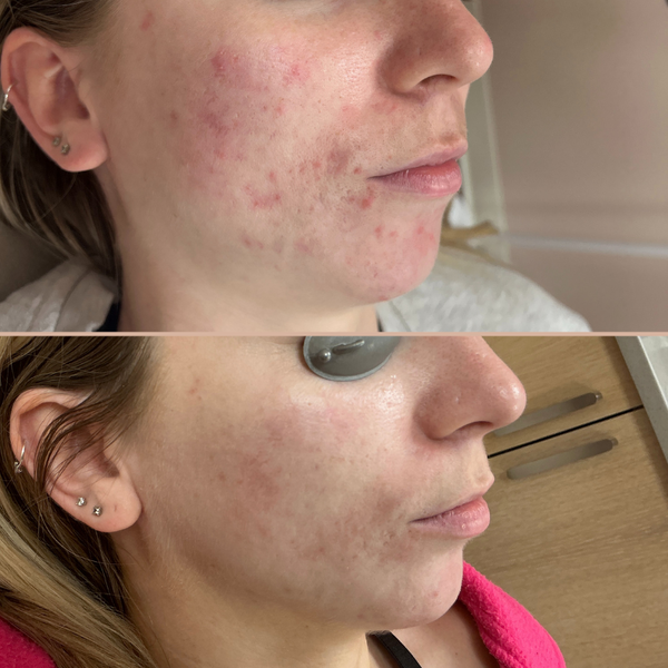 acne treatment nashville